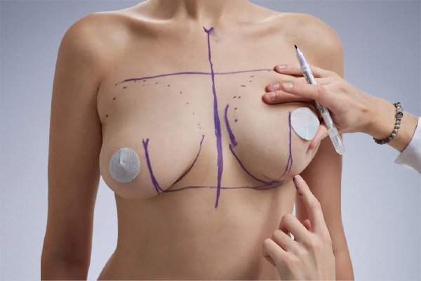 Breast Augmentation