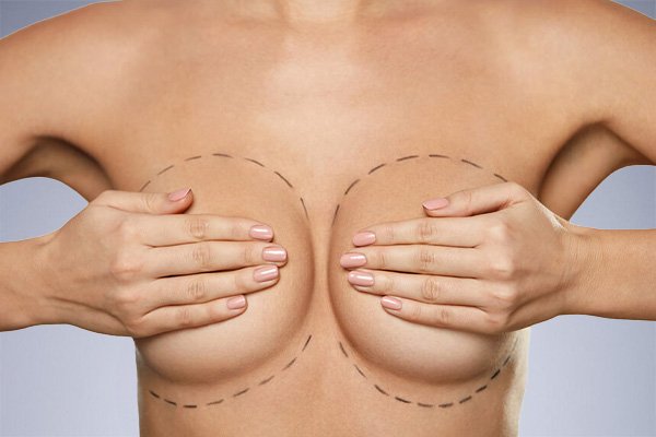 Breast Augmentation