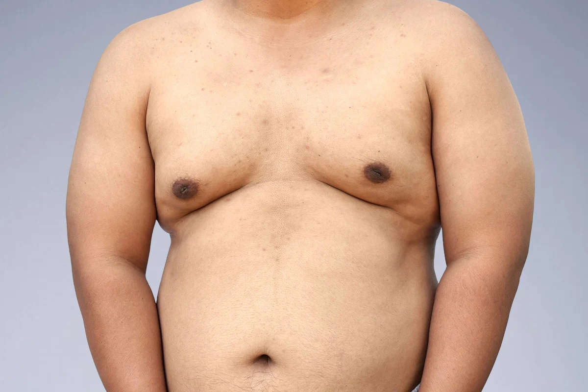 Breast Augmentation Risks