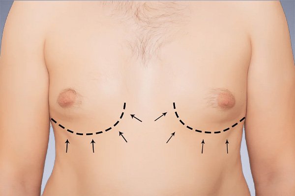 Breast Augmentation Risks