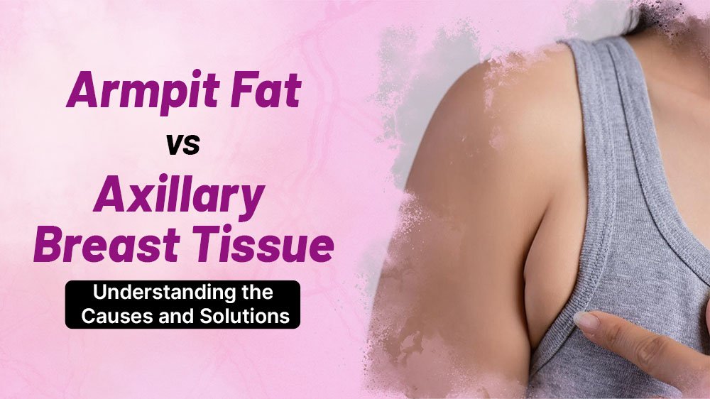 Armpit Fat vs. Axillary Breast Tissue